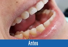 tratamento de abrasão ou erosão rocha tandartspraktijk